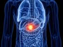 Here are signs of pancreatic cancer you can look out for 