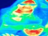 This remarkable thermal image shows up Bal's breast cancer as a red hotspot.
