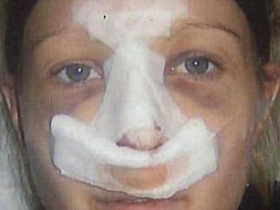 Catherine Roan decided to have cosmetic surgery to reduce the size of her nose after years of insults and name-calling.