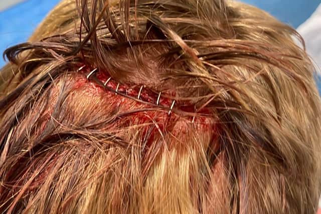 Kai had to be given nine staples in his head to close the wound.