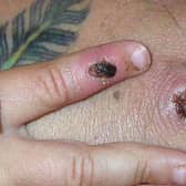 Monkeypox causes a rash which goes through different stages before finally forming a scab