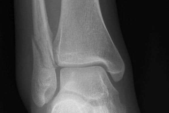 X-ray of fracture.