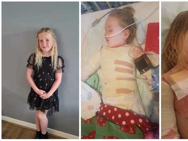 Little Courtney Abrahams, now seven, spent years battling back to full health after she suffered burns to more than a quarter of her body.