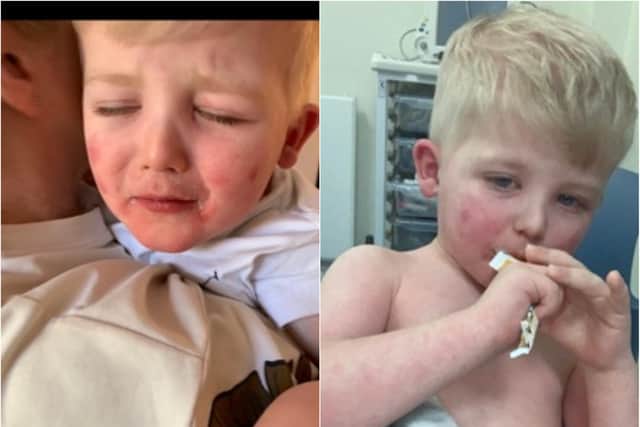 Freddie's symptoms included a rash all over his body, high fever and cracked lips.