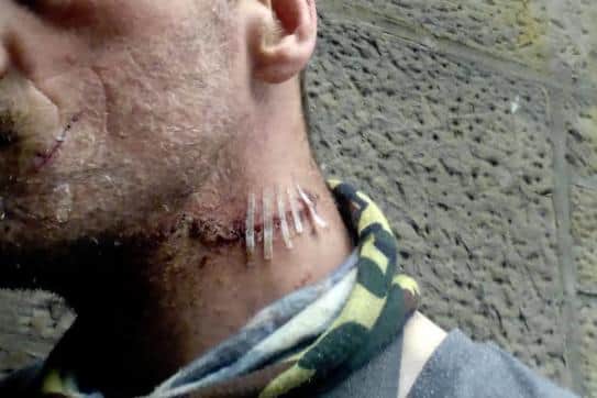 Robert Young needed stitches to his neck following the incident in Duddingston Row at the weekend.