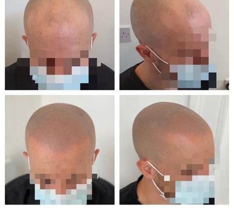 Scalp micropigmentation results on male head.