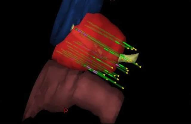 A 3D model of an HDR prostate brachytherapy implant