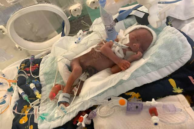 During his nine-month stay in hospital, Noah suffered from collapsed lungs, a grade two bleed on the brain, multiple bouts of sepsis, chronic lung disease and endured 12 operations including eye surgery.