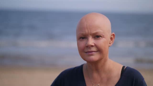 TV star Gail Porter shot to fame on shows such as Top of the Pops and Children in Need. She has opened up about her struggles with poor mental health and nervous breakdown and is now a motivational speaker. Gail was first diagnosed with alopecia in 2005 and has refused to wear wigs and hairpieces over the years.