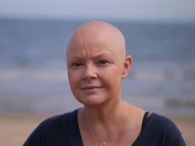 TV star Gail Porter shot to fame on shows such as Top of the Pops and Children in Need. She has opened up about her struggles with poor mental health and nervous breakdown and is now a motivational speaker. Gail was first diagnosed with alopecia in 2005 and has refused to wear wigs and hairpieces over the years.