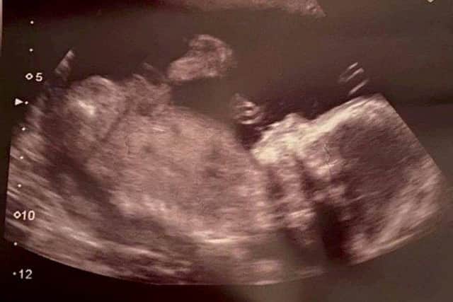 Ami Milligan 20 weeks scan