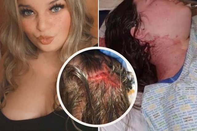 'For all he knew I could have been dying in the roadway but it looked like he didn’t care about me' - Edinburgh teen hit-and-run victim
