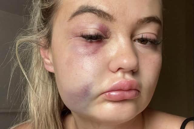 Liam Ritchie, 35, viciously punched victim Ellen Clarkson to the side of her face during an altercation at the Hot Dub Time Machine gig in August last year. Ritchie targeted Ms Clarkson, who was celebrating her birthday, after she was said to have become involved in a dispute with his sister following the show at the Capital’s Royal Highland Centre at Ingliston. The court heard Ms Clarkson, a social worker, suffered a fractured cheekbone during the attack and was said to have vomited after being rushed to hospital for treatment to her injuries. Ritchie, from Broxburn, West Lothian, pleaded guilty to an amended charge of assault to injury after the Crown agreed to delete the word “severe” from the complaint when he appeared at Edinburgh Sheriff Court on Wednesday, September 27. Sheriff John Cook sentenced Ritchie to pay a fine of £740.