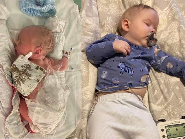Blake Stewart, pictured just after he was born, and then after his first operation, one day after he was born.