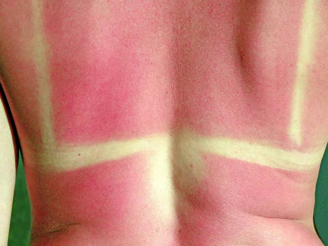Sunburn is painful, unsightly - and can also cause serious long term health problems.