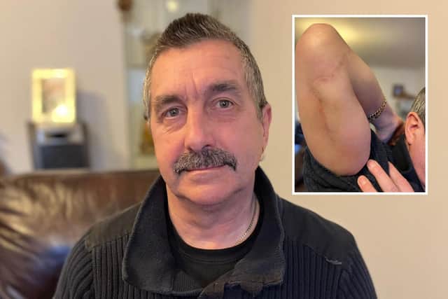 Ian was paid £150,000 in compensation after he was accidentally stabbed by a colleague