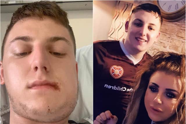 Darren Manson and his mother, Nicky, were walking back to Motherwell train station when the attack happened, leaving him in hospital with a broken jaw.