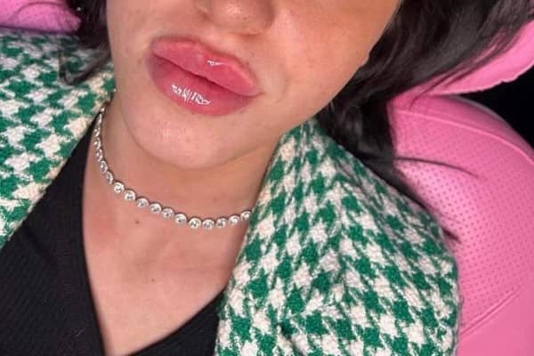 ome young women can become addicted to lip fillers