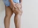 Throbbing or cramping pain, swelling, redness and warmth in a leg or arm is the main symptom of a blood clot (Photo: Shutterstock)