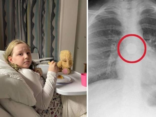 Child makes 'miraculous' recovery after swallowing battery then throwing it up in hospital