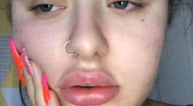 Anna suffered years of misery after getting lip fillers