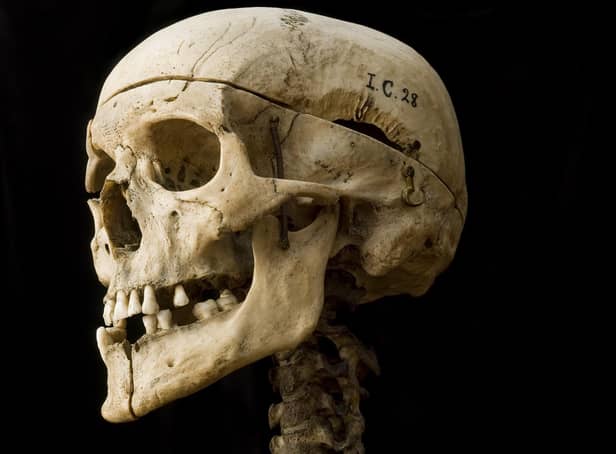William Burke's skeleton will be on display as part the exhibition Anatomy: A Matter of Death and Life at the National Museum of Scotland. Picture: Anatomical Museum collection, University of Edinburgh