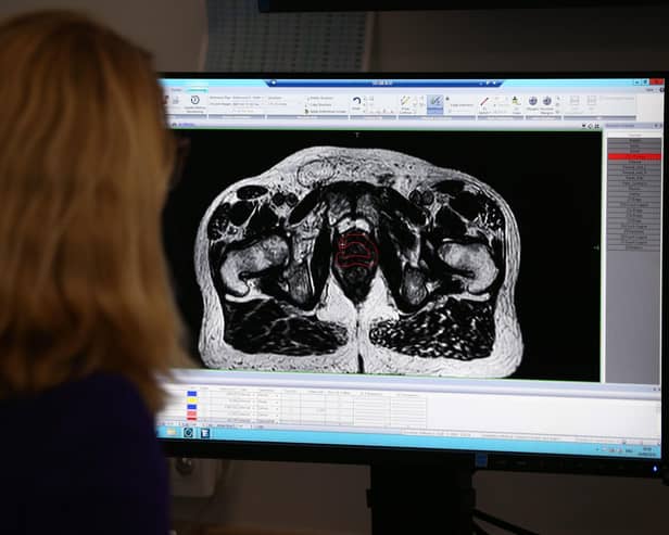 A consultant clinical oncologist examines a scan showing inside the body of a 65-year-old man diagnosed with prostate cancer (Picture: Yui Mok/PA)