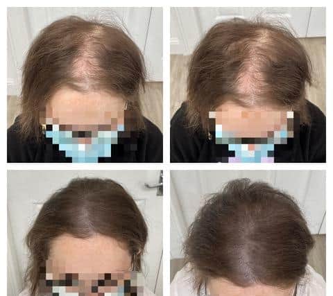 Scalp micropigmentation results of female head.