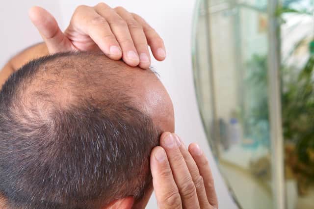 Scientists have suggested there may be a link between baldness and serious covid-19 cases (Shutterstock)