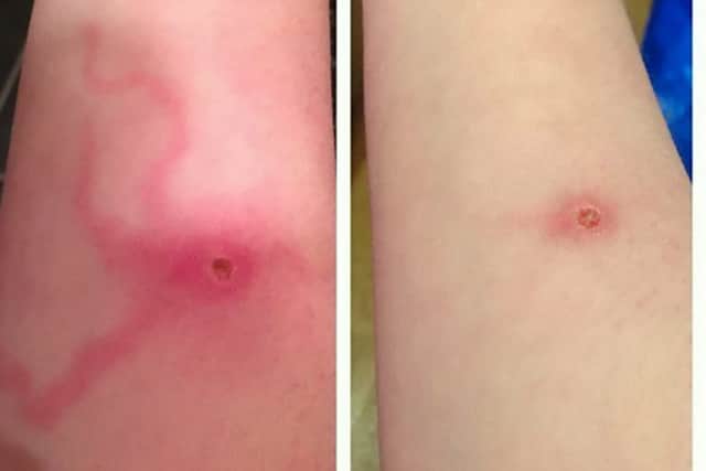 Bronwyn Gray's spider bite. Picture: HeMedia