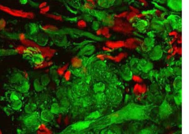 Brain tumour cells (green) and immune cells (red) printed by the research team. Picture: contributed