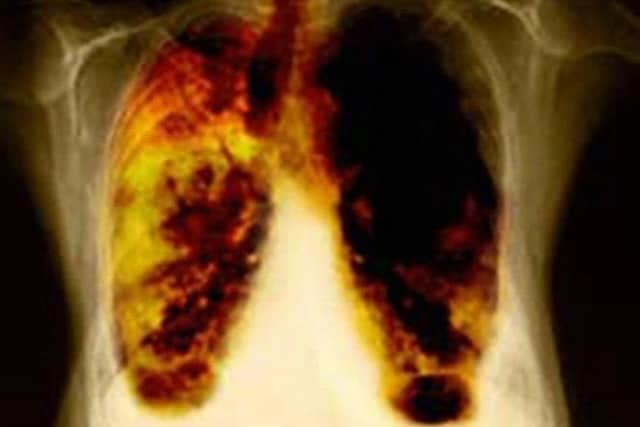 The drug trials could help lung cancer treatments. Picture: PA
