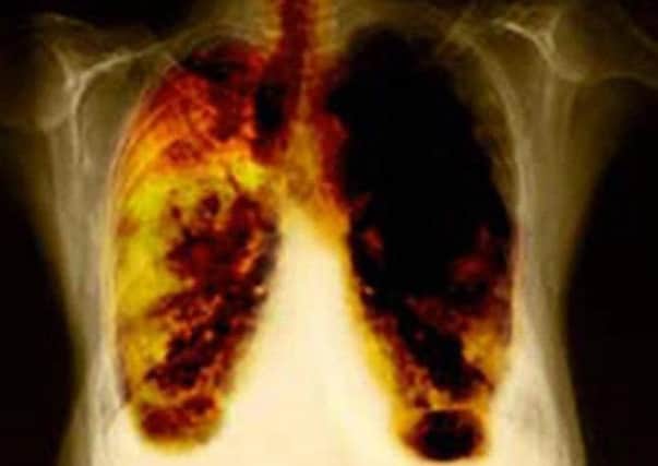 The drug trials could help lung cancer treatments. Picture: PA
