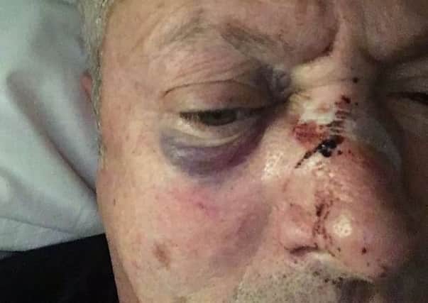 Nick Nairn received bruises to his face from the attack. Picture: Twitter/@NickNairn