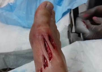Shane's foot following the attack.