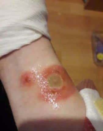 Ellie may need a skin graft after taking part in The Deodorant Challenge with classmates. Picture; SWNS