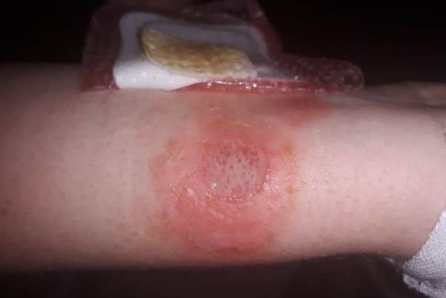 These are the horrific second-degree burns a ten-year-old girl was left with - after deodorant was sprayed on her in the latest school craze. Picture; SWNS