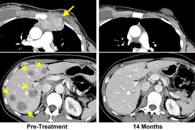 Images issued by the National Cancer Institute of before (left) and after, showing the apparent impact of immunotherapy on a woman who was diagnosed with breast cancer, following months of treatment to eliminate the disease. Picture: National Cancer Institute/PA Wire