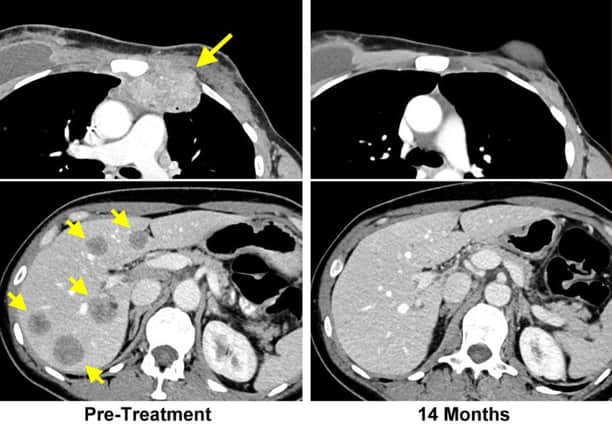 Images issued by the National Cancer Institute of before (left) and after, showing the apparent impact of immunotherapy on a woman who was diagnosed with breast cancer, following months of treatment to eliminate the disease. Picture: National Cancer Institute/PA Wire