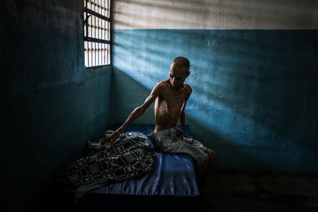 Schizophrenic patient, Omar Mendoza is badly malnourished, and only weighs 35 kilos. The state psychiatric hospital where he lives has been crippled by acute food and medicine shortages. Picture: Meridith Kohut/The New York Times