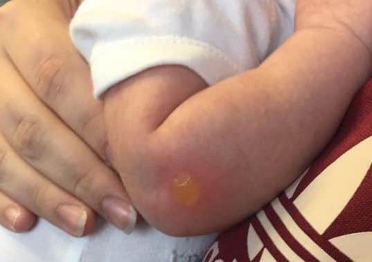 Chloe Louise Martin and her sister Amy Harnaman were coming back from the school run with 5 week old sophia in her pram.
A nearby smoker thoughtlessly flicked his cigarette butt and it landed in Sophia's pram.

Picture: Contributed
