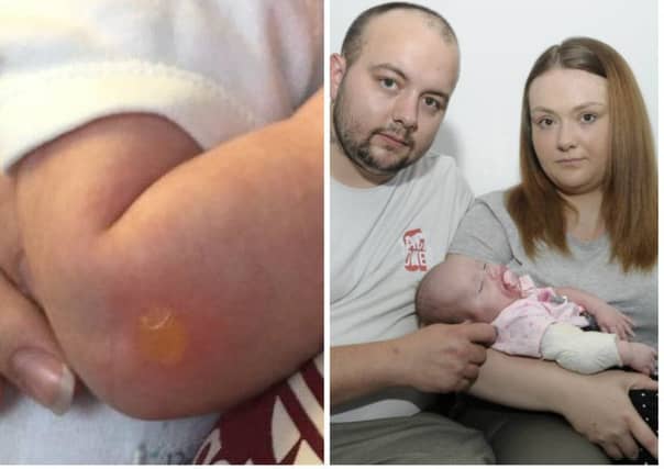 Baby Sophia was burnt after a smoker tossed a butt into her pram. Pictures: Contributed/Neil Hanna