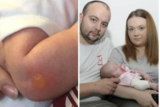 Baby Sophia was burnt after a smoker tossed a butt into her pram. Pictures: Contributed/Neil Hanna
