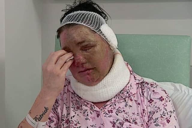 Teresa McCann has been scarred for life after she was attacked with acid at her home in Edinburgh.