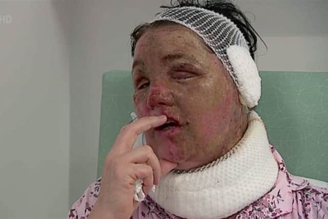 Local tv images of Teresa McCann who has been left scarred for life after an orange substance was doused on her face and body. with acid by a man wearing a balaclava.
Pic: STV News/Universal News And Sport (Scotland)