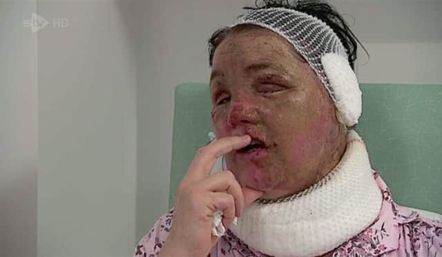 Local tv images of Teresa McCann who has been left scarred for life after an orange substance was doused on her face and body. with acid by a man wearing a balaclava. 
Pic: STV News/Universal News And Sport (Scotland)
