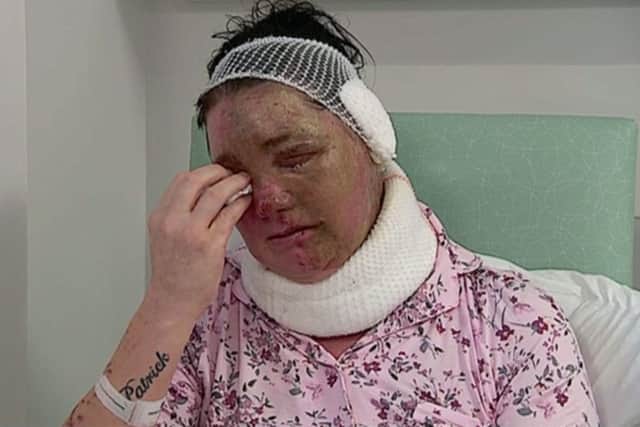 TV image of Teresa McCann who has been left scarred for life after an orange substance was doused on her face and body. Picture: