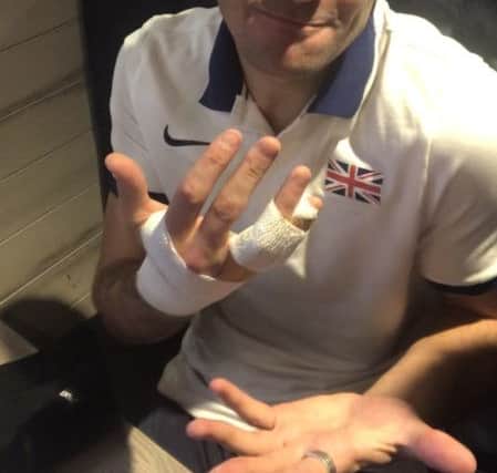 Guy Learmonth shows off his broken finger